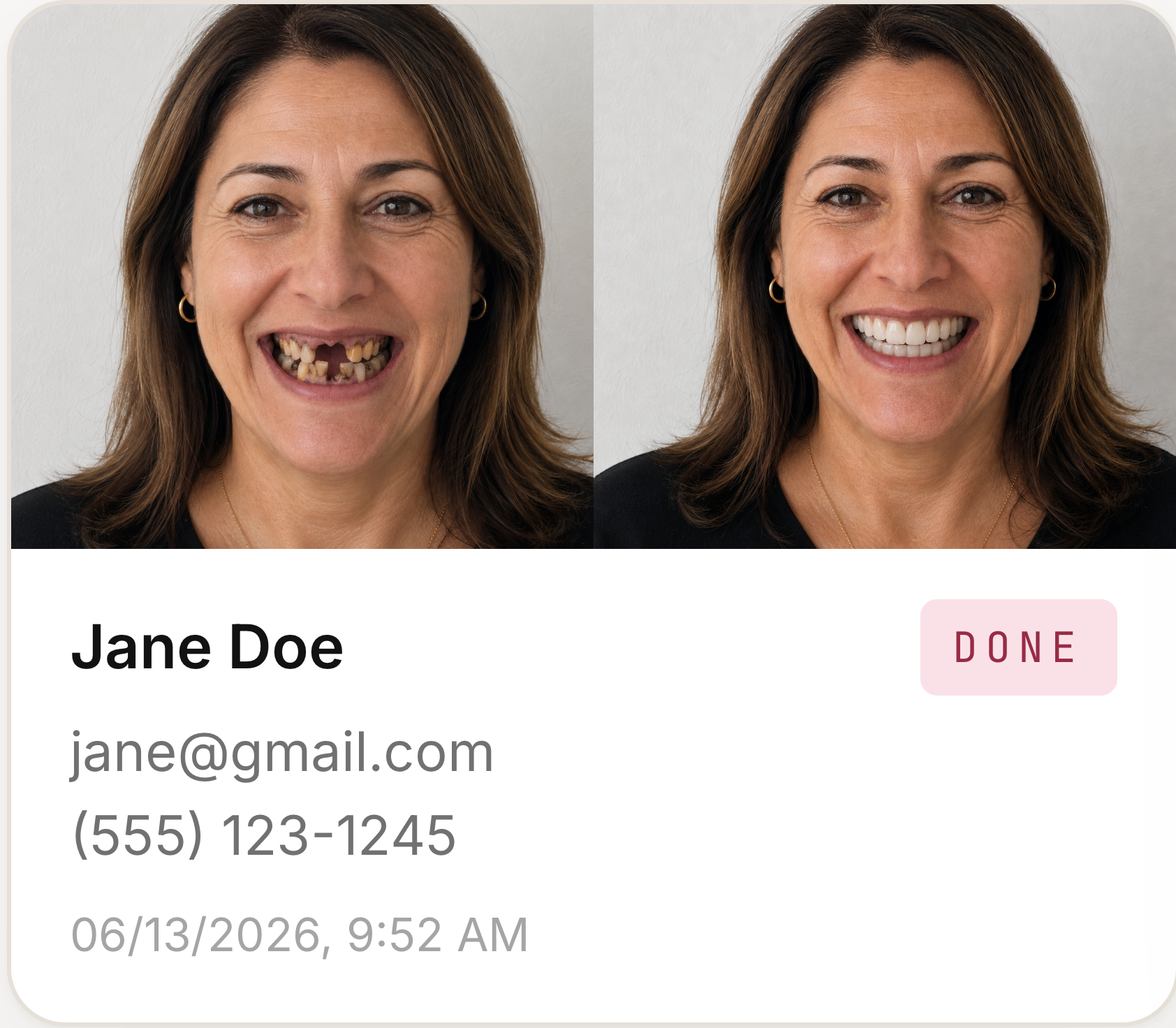 Smile Simulator before and after — Fausto Gutierrez